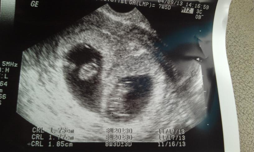 She chose life for her triplets during an unplanned pregnancy at 42.